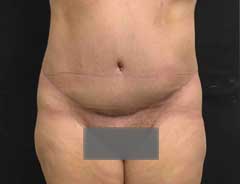 After Extended Tummy Tuck front