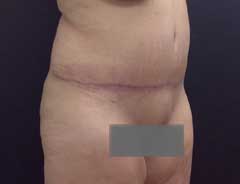 After Extended Tummy Tuck tween