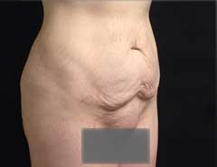 Angle view, tummy tuck full, before