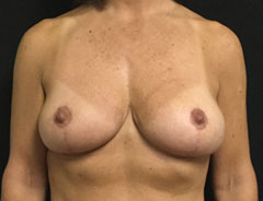 Breast Lift Full, front, after