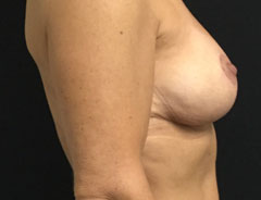 Breast Lift Full, side, after
