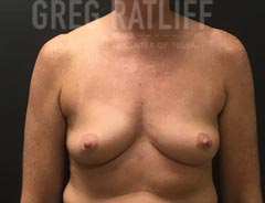 Breast Aug - Front View - Before Surgery