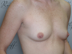 Half Profile before breast augmentation: 34A