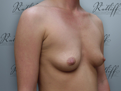 Half Profile before breast augmentation: 36A