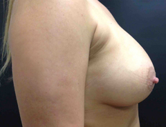 Side View, Breast Augmenation, After: 34C