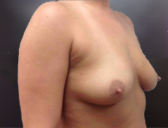 Angle view, breast augmentation before: 34B