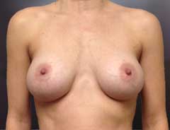 Front view, breast augmentation, after