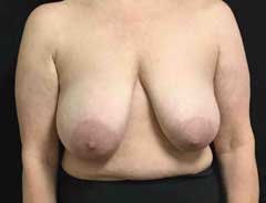 Before Breast Lift front