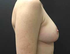 After Breast Lift side