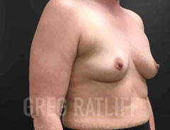 Breast Aug - Oblique View - Before Surgery
