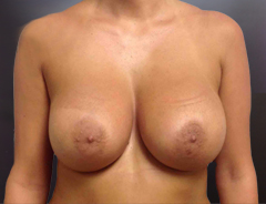 Front view, after breast augmentation: 32D