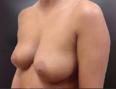 Angle view, breast augmentation before: 32B