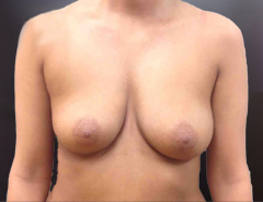 Front view, before breast augmentation: 32B