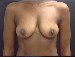 Front view, breast augmentation, before