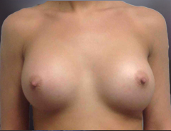 Front View After breast augmentation:34C Full