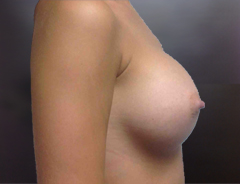 Side View, Breast Augmenation, After: 34C Full