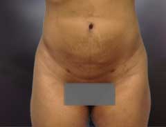 After Liposuction front