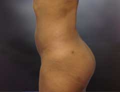 After Liposuction side