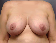 Front view breast augmentation & lift: FullerHighe