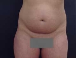 Before Liposuction front