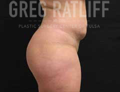 After Liposuction side