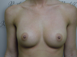 Front view, before breast augmentation: 34B