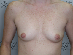 Front view, before breast augmentation: 34A