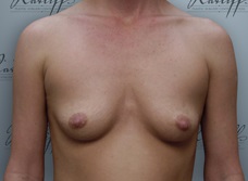 Front view, before breast augmentation: 36A