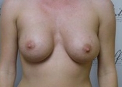 Front View After breast augmentation: 36A to 36D