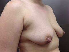 Angle view, breast augmentation & lift before: 36B