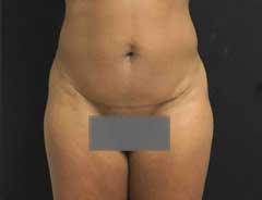 After Mini Tummy Tuck Front