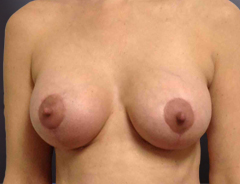 Front view breast aug & lift:Small 32C