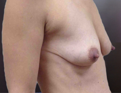 Angle view, breast augmentation & lift before: 32A