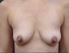 Front view, before breast augmentation & lift: 32A