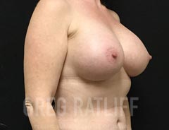 Breast Aug - Oblique View - After Surgery