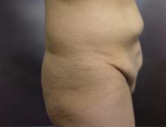 Before Skin Only Tummy Tuck Side