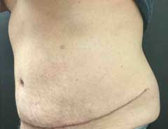 After Skin Only Tummy Tuck Tween - Male