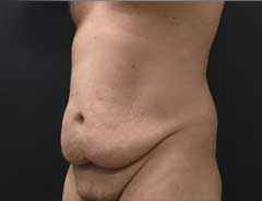 Before Skin Only Tummy Tuck Tween - Male