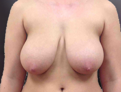 Front view, breast reduction, before