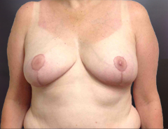 Front view, breast reduction, after