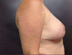 Side view, breast reduction, after