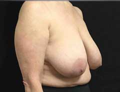 Angle view, breast lift, before