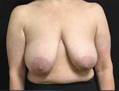 Front view, breast lift, before