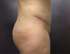 Side view, tummy tuck full, after