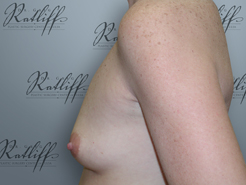 Profile before breast augmentation: 34A