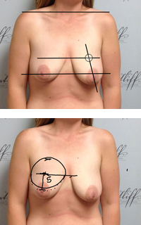 Patient with diagrams measuring breast