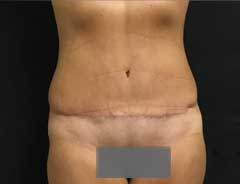 full tummy tuck - front - after