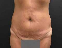 full tummy tuck - front - before