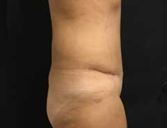 full tummy tuck - side - after