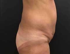 full tummy tuck - side - before